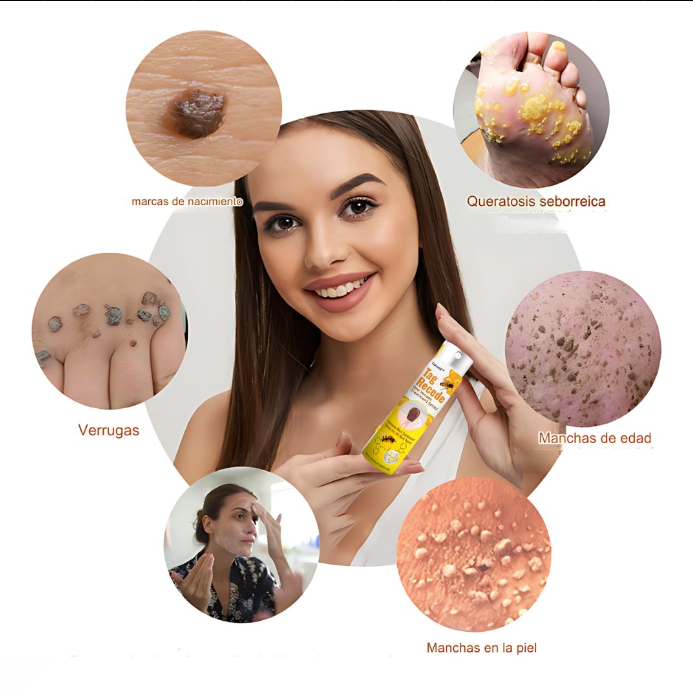 Crema para eliminar verrugas