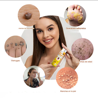 Crema para eliminar verrugas